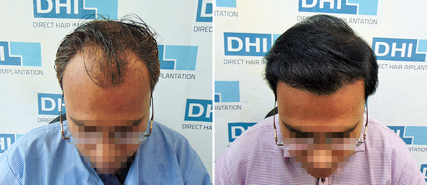 DHI before & after hair transplant results